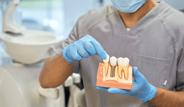 Full Mouth Dental Implants in 2025: An In Depth Patient Guide