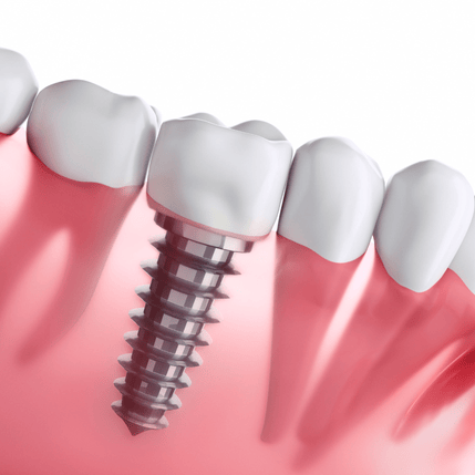 Dental implant illustration showing implant post integrated into gum tissue, representing full mouth dental implants and their stability compared to traditional dentures.