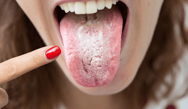 White Tongue: Causes, Symptoms, and How to Get Rid of It Naturally