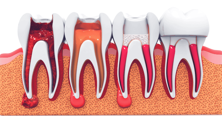 Root canal treatment process illustration with dental tools, highlighting patient care and aftercare in a dental setting.