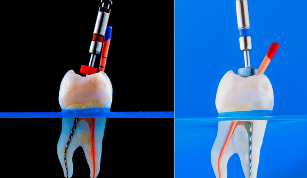 Illustration comparing root canal treatment techniques, highlighting dental tools and procedures relevant to oral health education and treatment options.