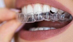 Close-up of a mouth with clear aligners, illustrating discreet orthodontic treatment options for cosmetic dentistry.