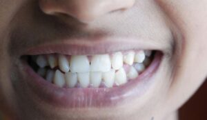 Close-up of a smile showcasing healthy teeth, emphasizing dental aesthetics and proper alignment, relevant to discussions on oral health and crossbite prevention.