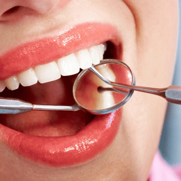 Close-up of a patient's mouth during a dental examination, showcasing healthy teeth and dental tools, representing expert dental care at Dental Krafts in Sacramento.